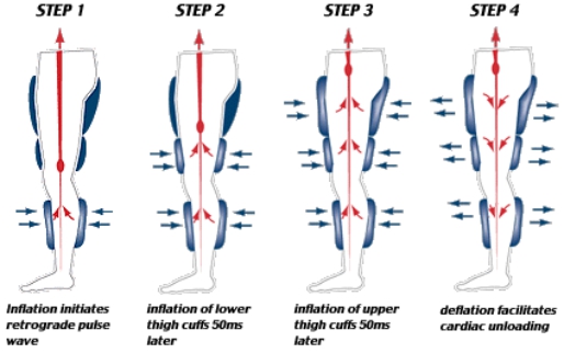 EECP procedure