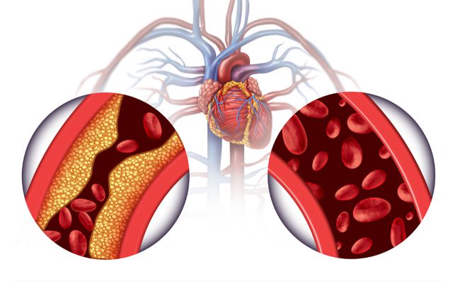 What's ECP therapy? A non-invasive treatment for cardiac rehabilitation